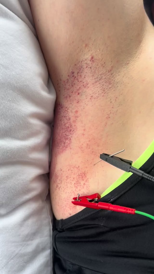 When your subscap tries to sabotage your snatch 😅🏋🏼♀️
Today’s episode of ✨Free The Shoulder✨ featuring:
⚡️ Dry need